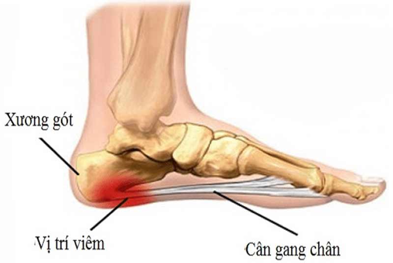 bệnh viêm cân gan chân biểu hiện như thế nào