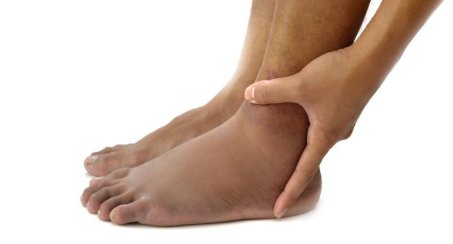 Triệu Chứng và Dấu hiệu nhận biết bệnh suy giãn tĩnh chân