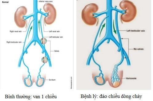 Dấu hiệu nhận thấy bệnh giãn tĩnh mạch thừng tinh