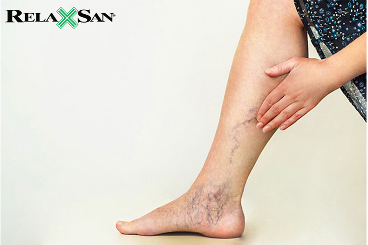 Giãn tĩnh mạch đang phổ biến hiện nay và ảnh hưởng tới sinh hoạt rất nhiều