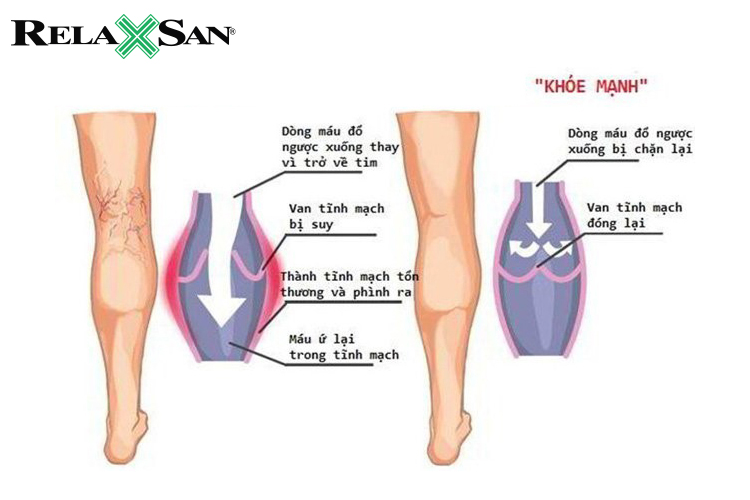 Suy giãn tĩnh mạch là một bệnh phổ biến