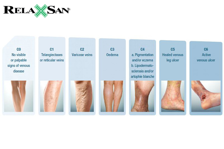 Giãn tĩnh mạch có 6 mức độ nặng nhẹ khác nhau đáng chú ý