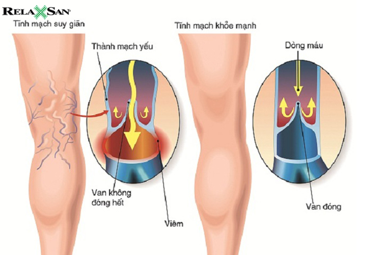 kem-gian-tinh-mach-giup-luu-thong-mau-va-tinh-trang-tinh-mach