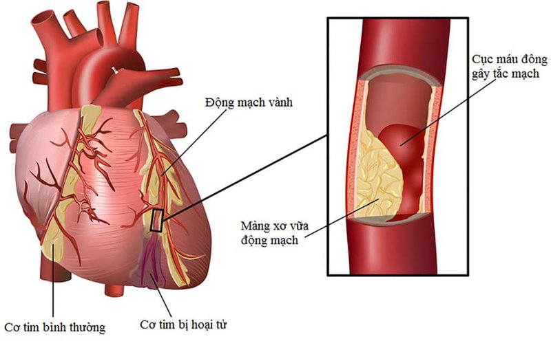 Thông Tin Bệnh Mạch Vành: Nguyên Nhân, Triệu Chứng Và Cách Điều Trị