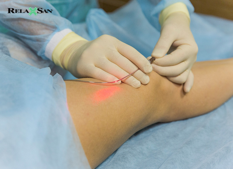 Cắt bỏ bằng laser là lựa chọn điều trị giãn tĩnh mạch ít xâm lấn