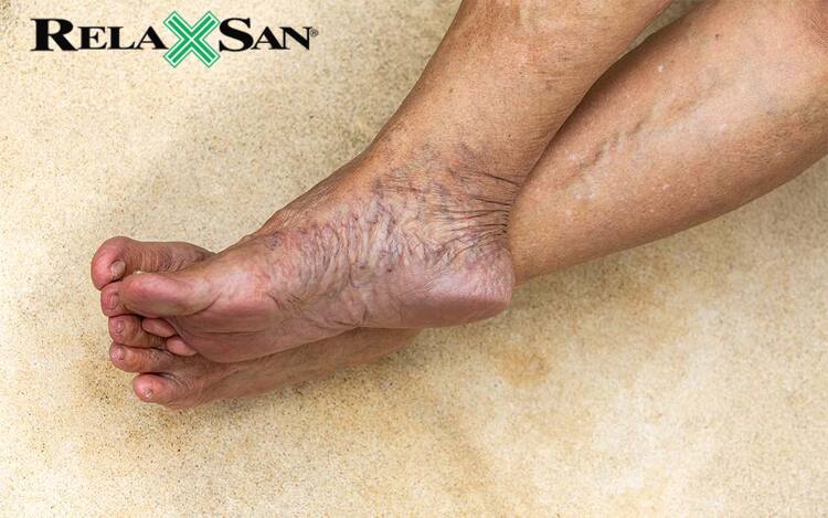 Các tĩnh mạch sâu bên trong chân trở nên mở rộng có thể gây đau và sưng chân