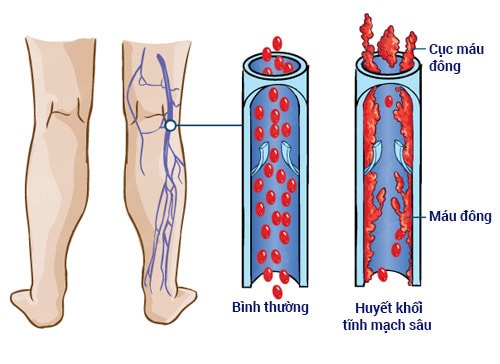 Biện pháp phòng tránh bị huyết khối