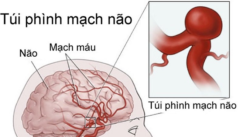 Phình mạch máu não là gì? có nguy hiểm không