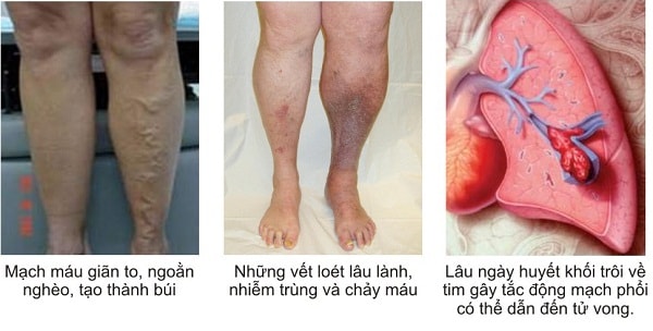 Nguyên nhân dẫn giãn tĩnh mạch