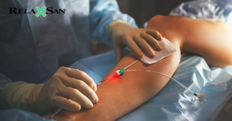 Điều trị tĩnh mạch mạng nhện bằng laser bề mặt